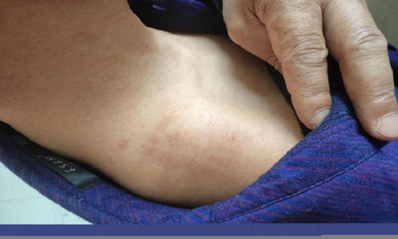 一天下来,村民们的肩膀勒出了明显的伤痕.通讯员 杜发美 摄