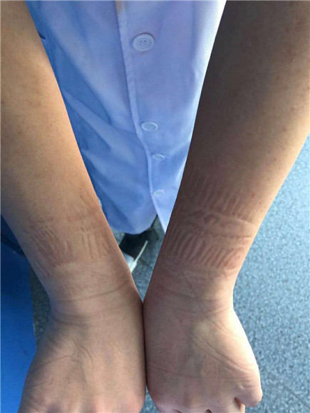 每天忙碌下来,姚素鑫的手上全是防护服的勒痕.受访者供图 华龙网发